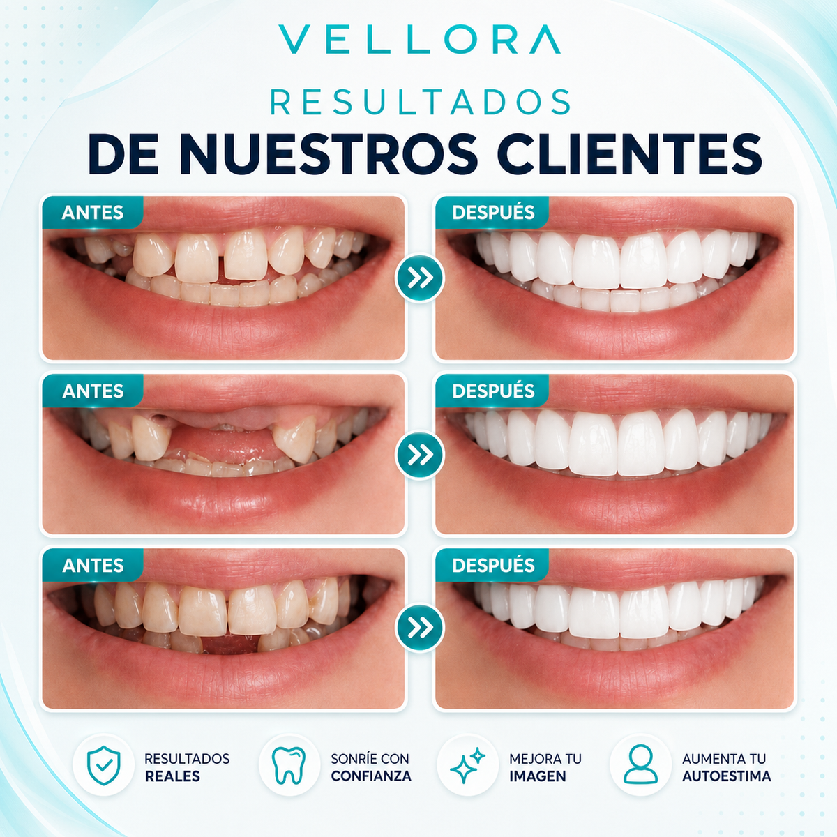 Carillas dentales instantáneas