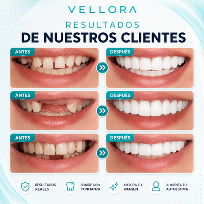 Carillas dentales instantáneas